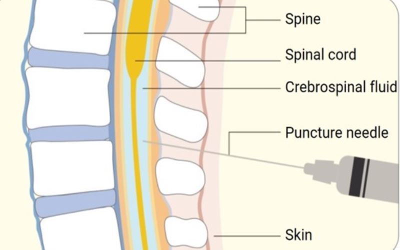 Intrathecal administration involves delivering medication directly into the spinal canal, bypassing the blood-brain barrier.