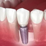 Dental Implants