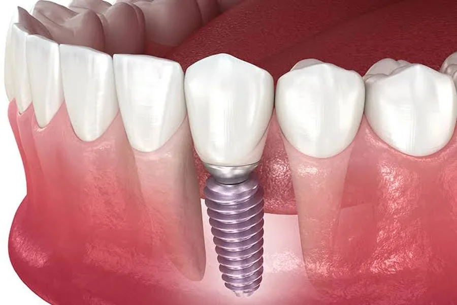 Dental Implants