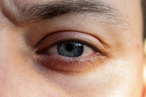 When Eyelid Changes Are More Than a Cosmetic Question